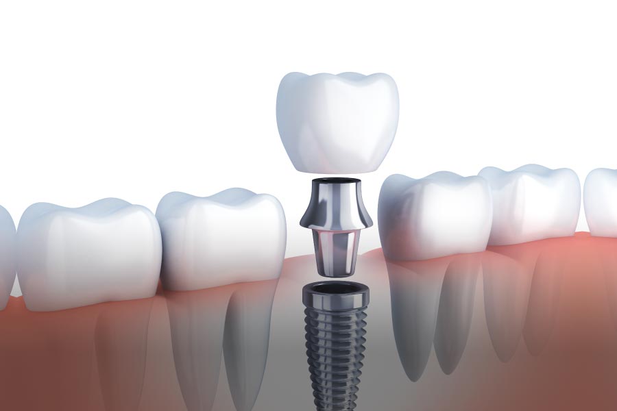 Olympia Dental Implants