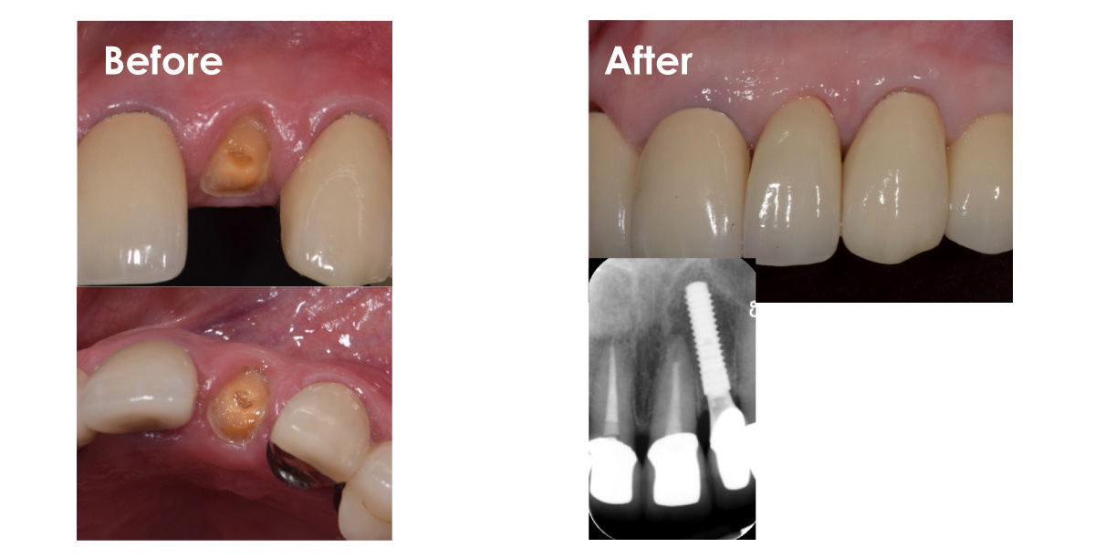 Olympia Dental implants